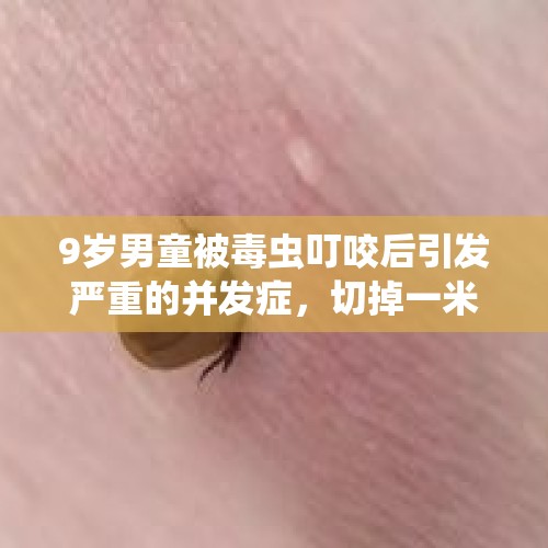 9岁男童被毒虫叮咬后引发严重的并发症，切掉一米肠管才保住命！ - 今日头条