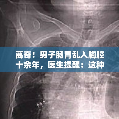 离奇！男子肠胃乱入胸腔十余年，医生提醒：这种情况一定要定期复查 - 今日头条